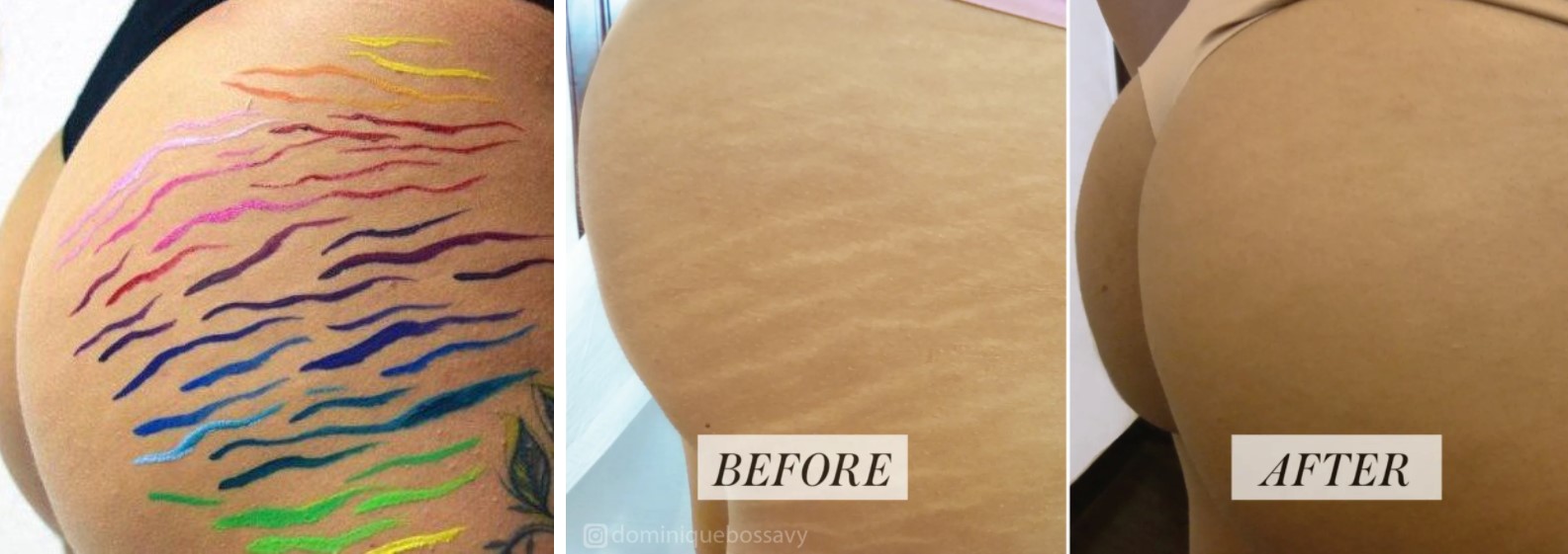 hide stretch marks tattoo artist uses tiger stripes and natural skin tone ink to hide stretch marks