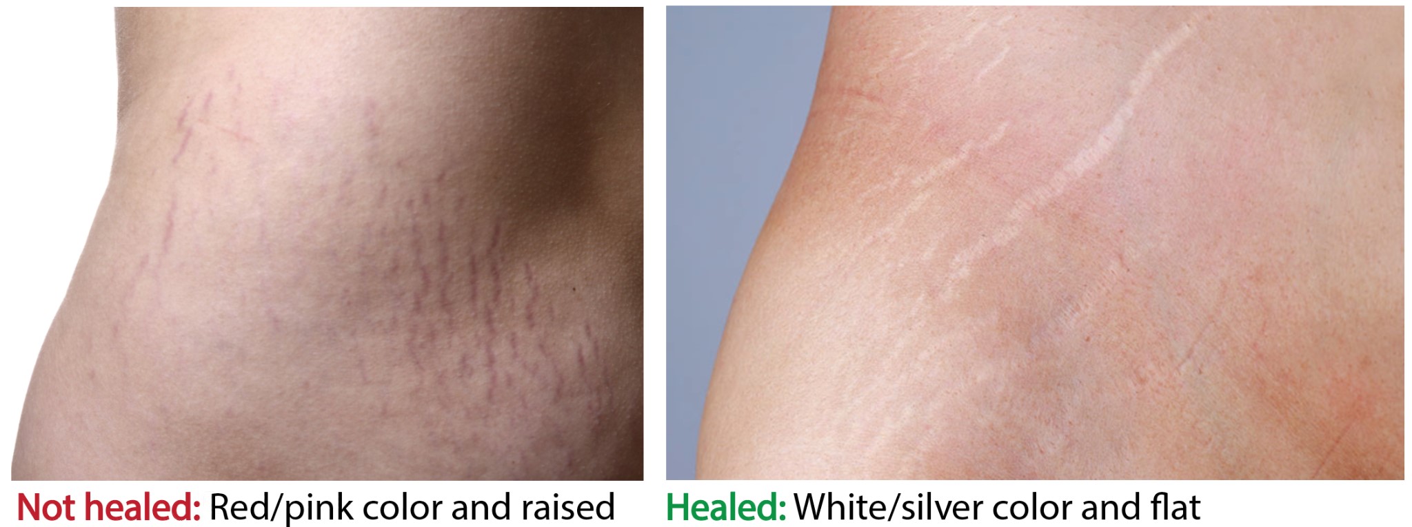 stretch marks raised stretch marks vs healed stretch marks
