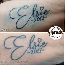 tattoo healing after laser treatment tattoo healing after laser treatment