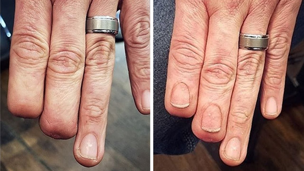 tattoo missing nails scar