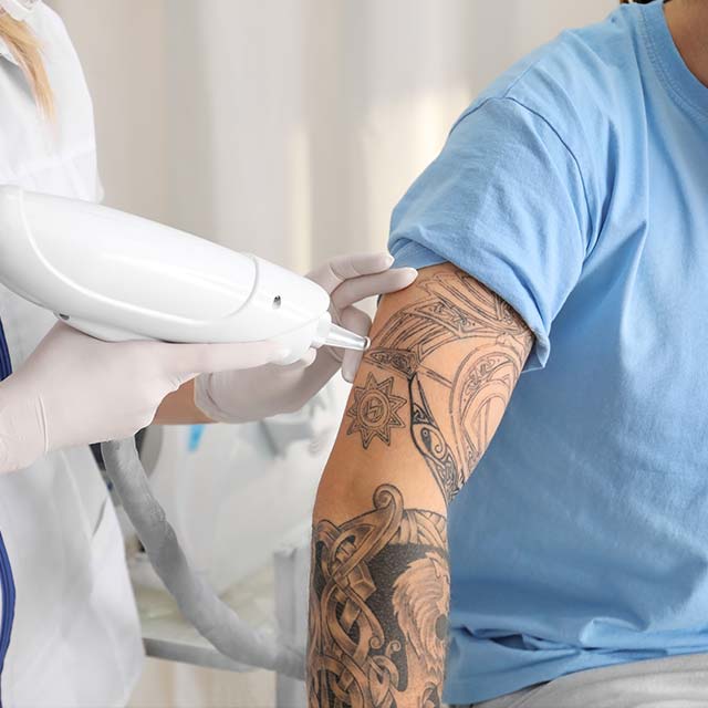 tattoo_removal_laser tattoo removal procedure at a tattoo shop