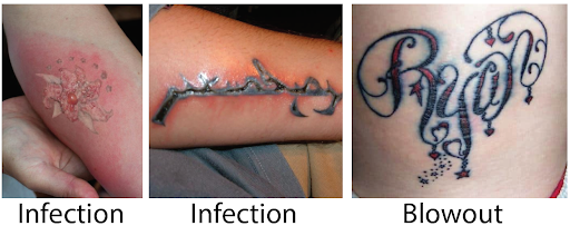 people with infected tattoos should get medical or professional advice people with infected tattoos should get medical or professional advice