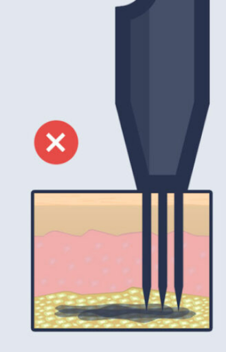 Tattoo blowout graphic tattoo blowout caused by the tattoo artist putting too much ink in the third layer of the skin