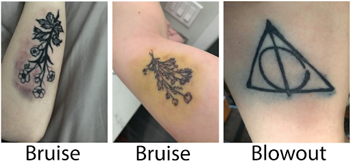 tattooed skin can bruise easily around the tattooed area tattooed skin can bruise easily around the tattooed area